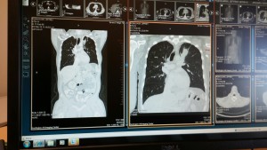 CT Scan of Lung Tumor