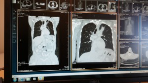 Comparing scans to see how the chemotherapy has been working. Tumor shrinking, lung expanding... at least a little.