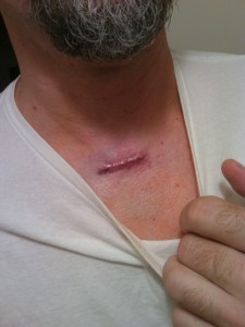My awesome scar. From my awesome surgeon.