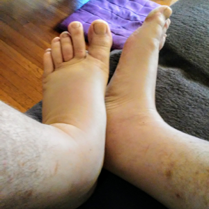 A pair of swollen feet, in all their glory.