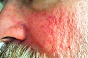 Skin rash from poziotinib, close-up of face.