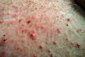Skin rash from poziotinib, close-up of chest